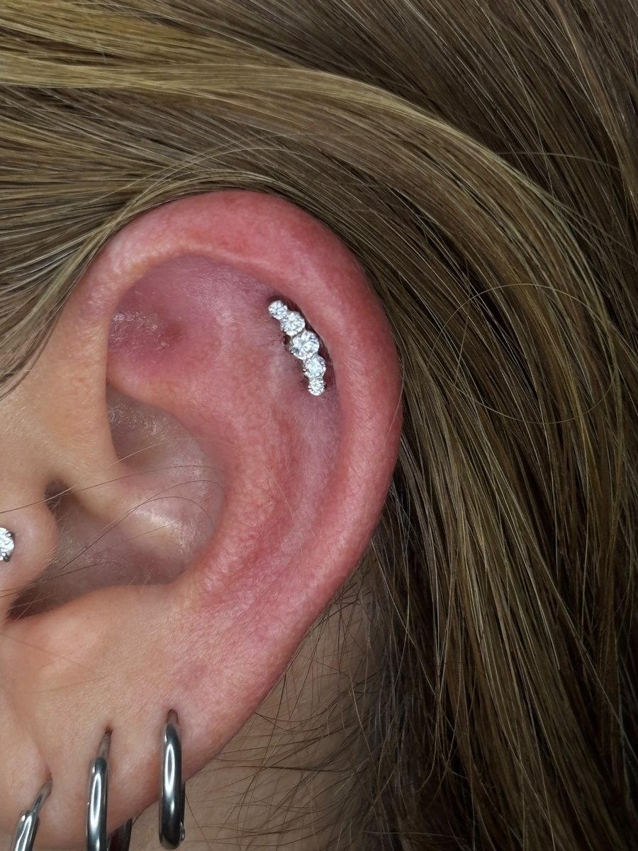 Cluster auricular em titânio com zircônia